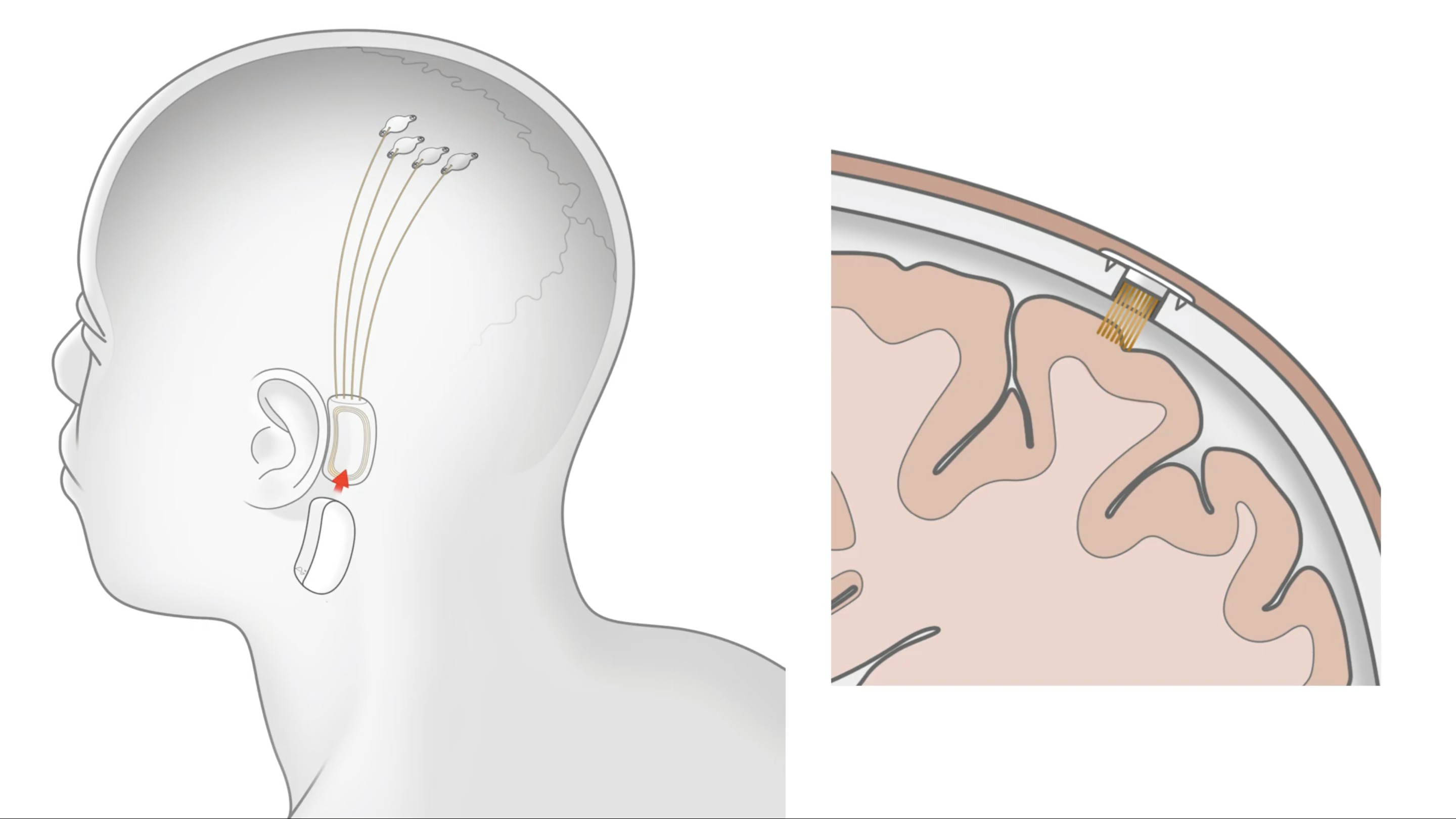 إيلون ماسك - شريحة Neuralink Implant